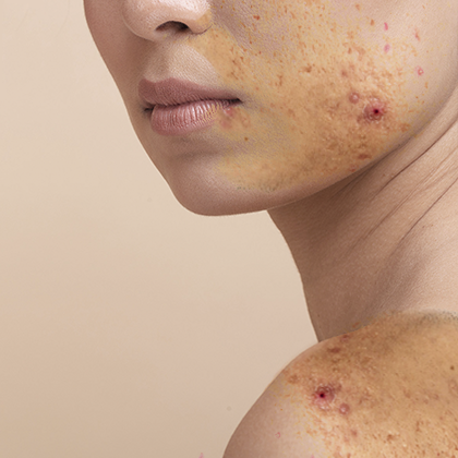 Proderma, Acné