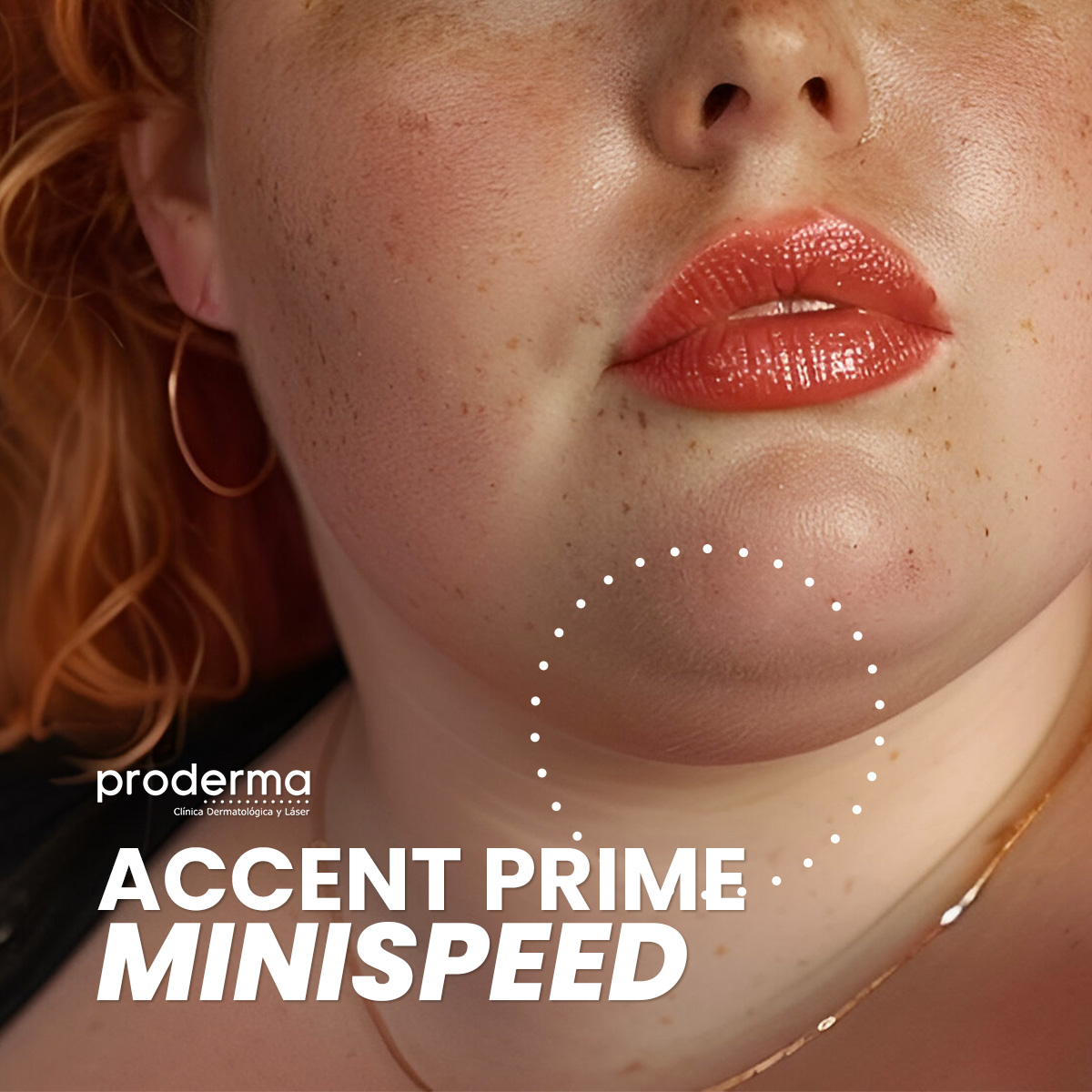 Proderma,  dermatología,  minispeed, tratamiento estético,  clínica