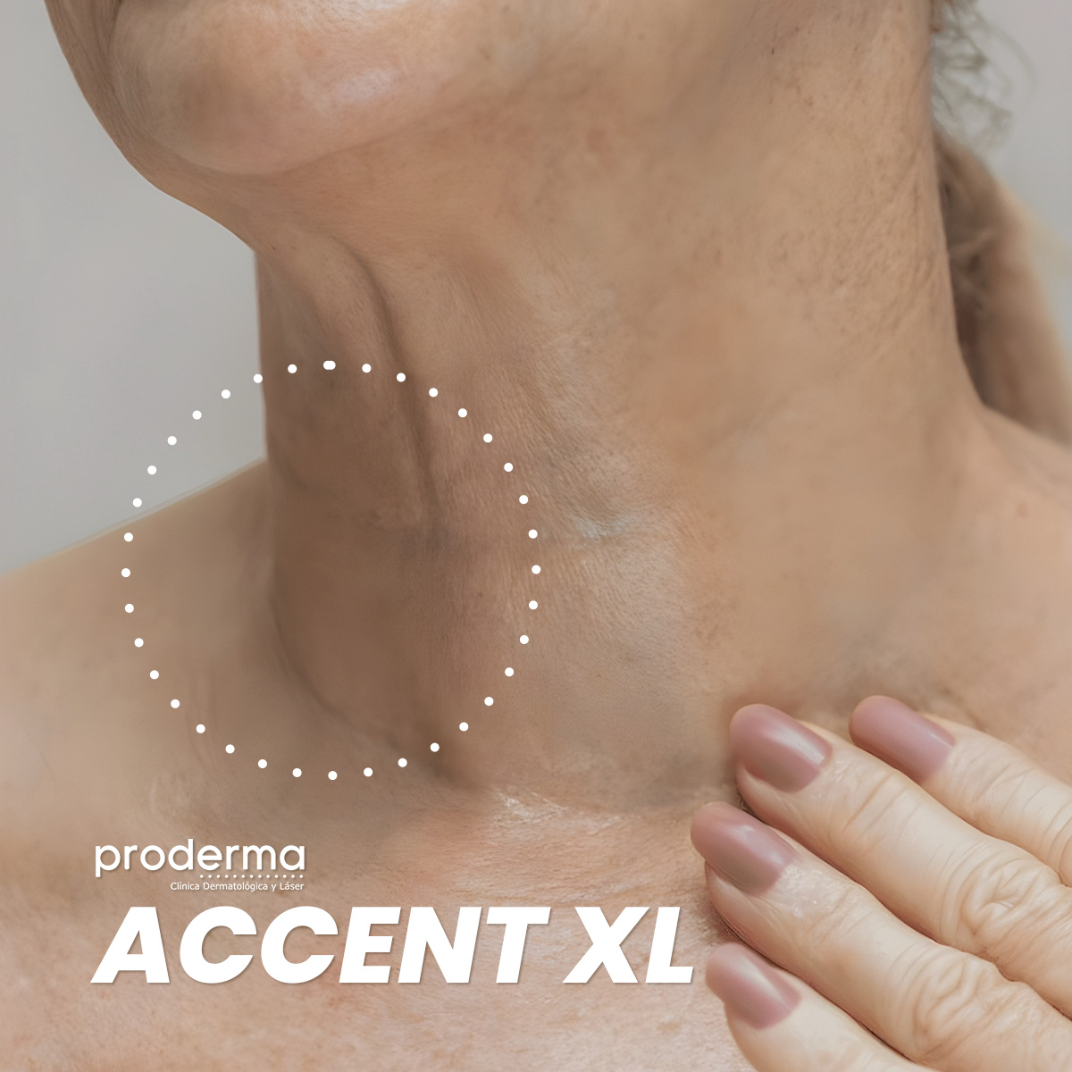 Proderma,  dermatología,  accentxl, flacidez, firmeza, clínica 
