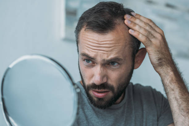 Caída del cabello, alopecia