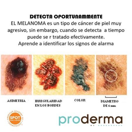 Cancer de piel, carcinoma, melanoma