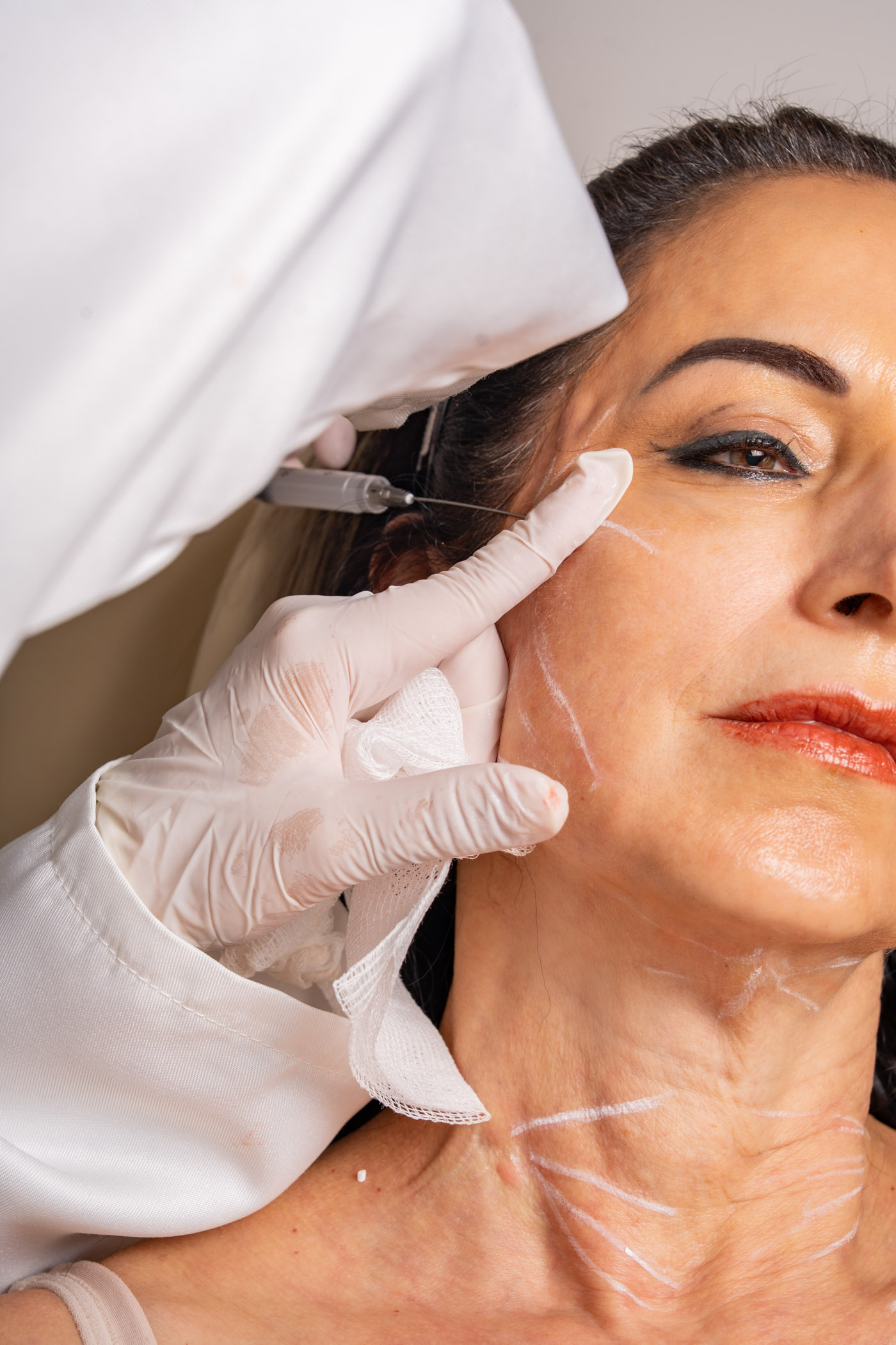 Proderma, dermatología, colágeno, bioestimulantes, elasticidad, clínica, Sculptra, Lenisna, Juvelook, Ovidia, Radiesse, Ultracol 