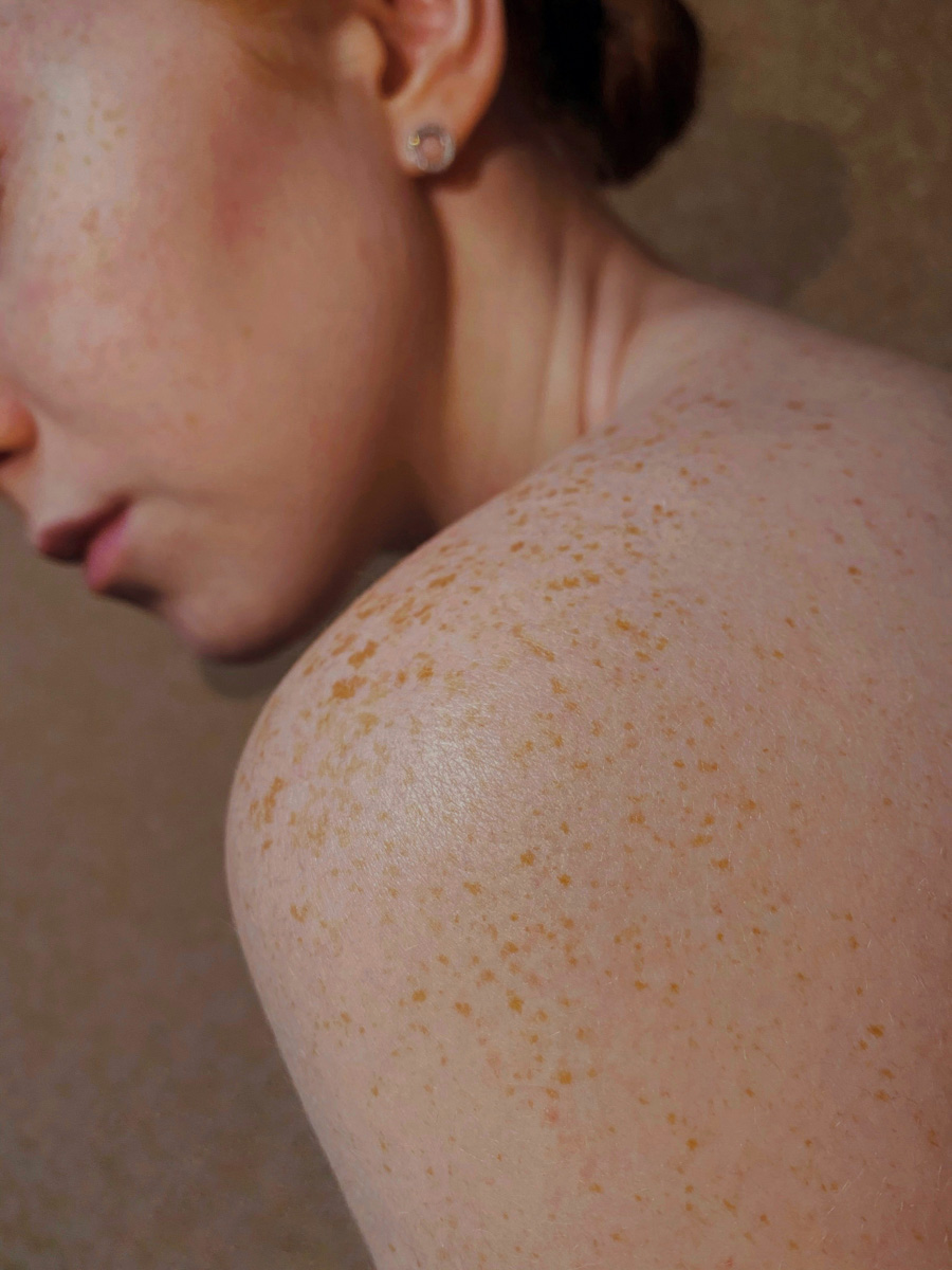 Proderma, dermatología, cáncer, piel, quirúrgica, tampico 