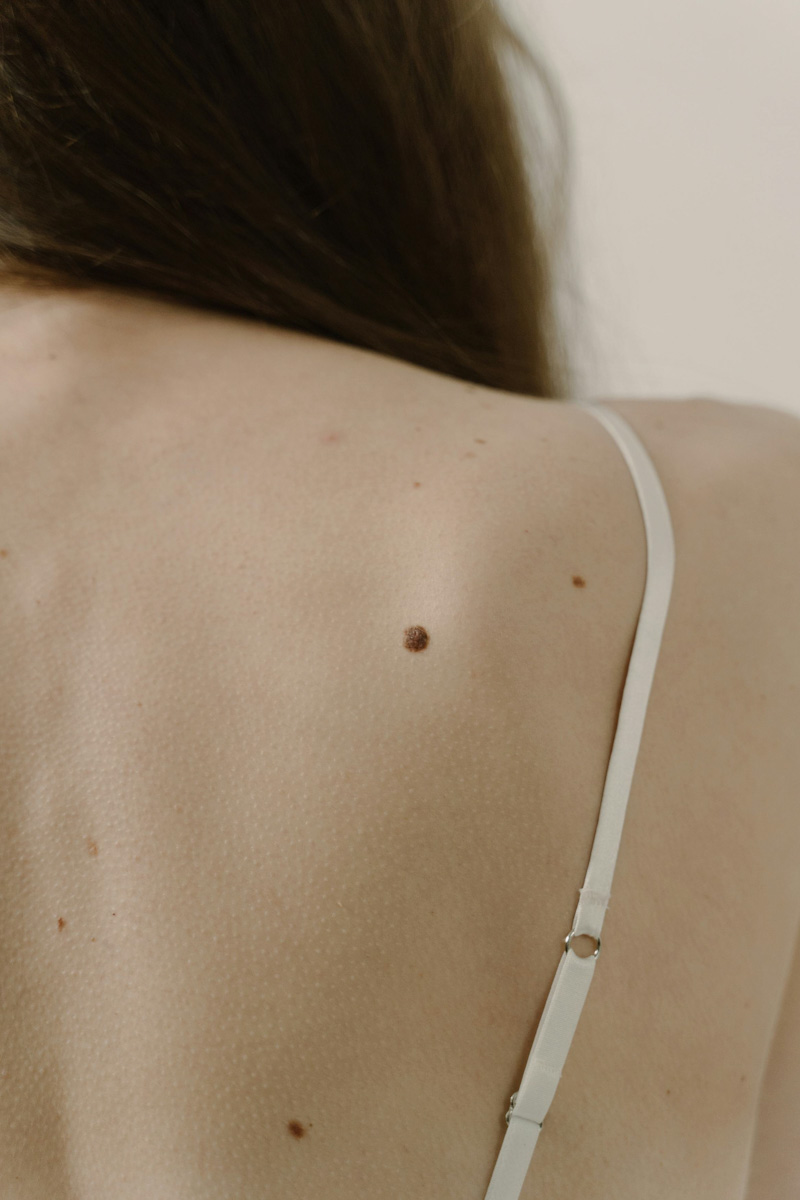 Proderma, dermatología,  Oncoquirúrgica,  cáncer de piel, cáncer