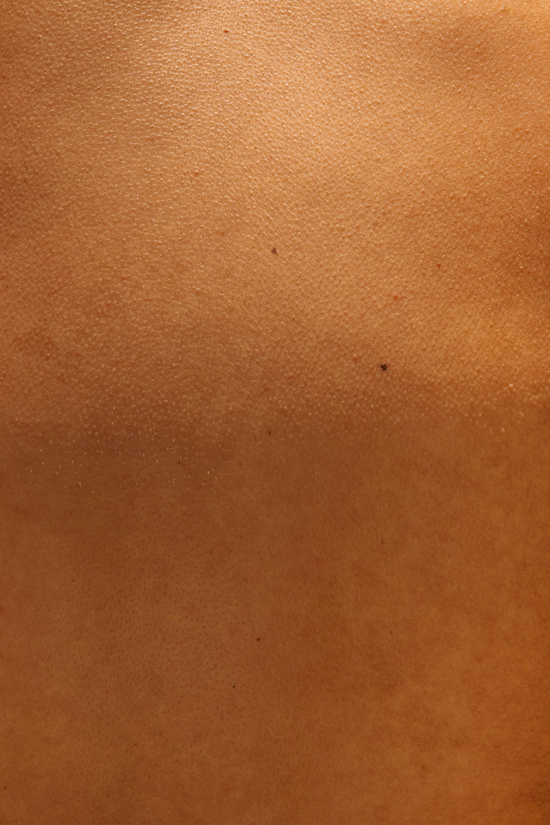 Proderma, criocirugía,  cirugía,  precancerosas,  clínica 