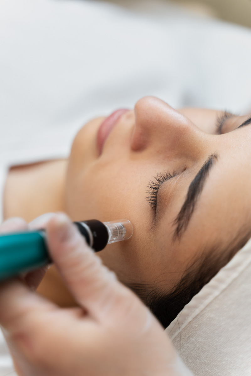Proderma, dermatología,  peeling, micropeeling
