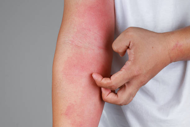Dermatitis