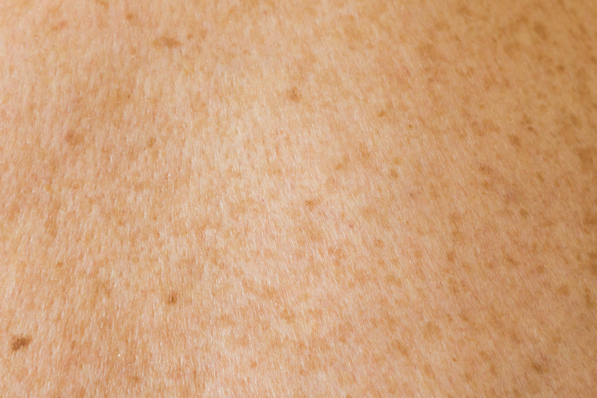 Proderma, dermatología,  clínica, melanoma, cáncer