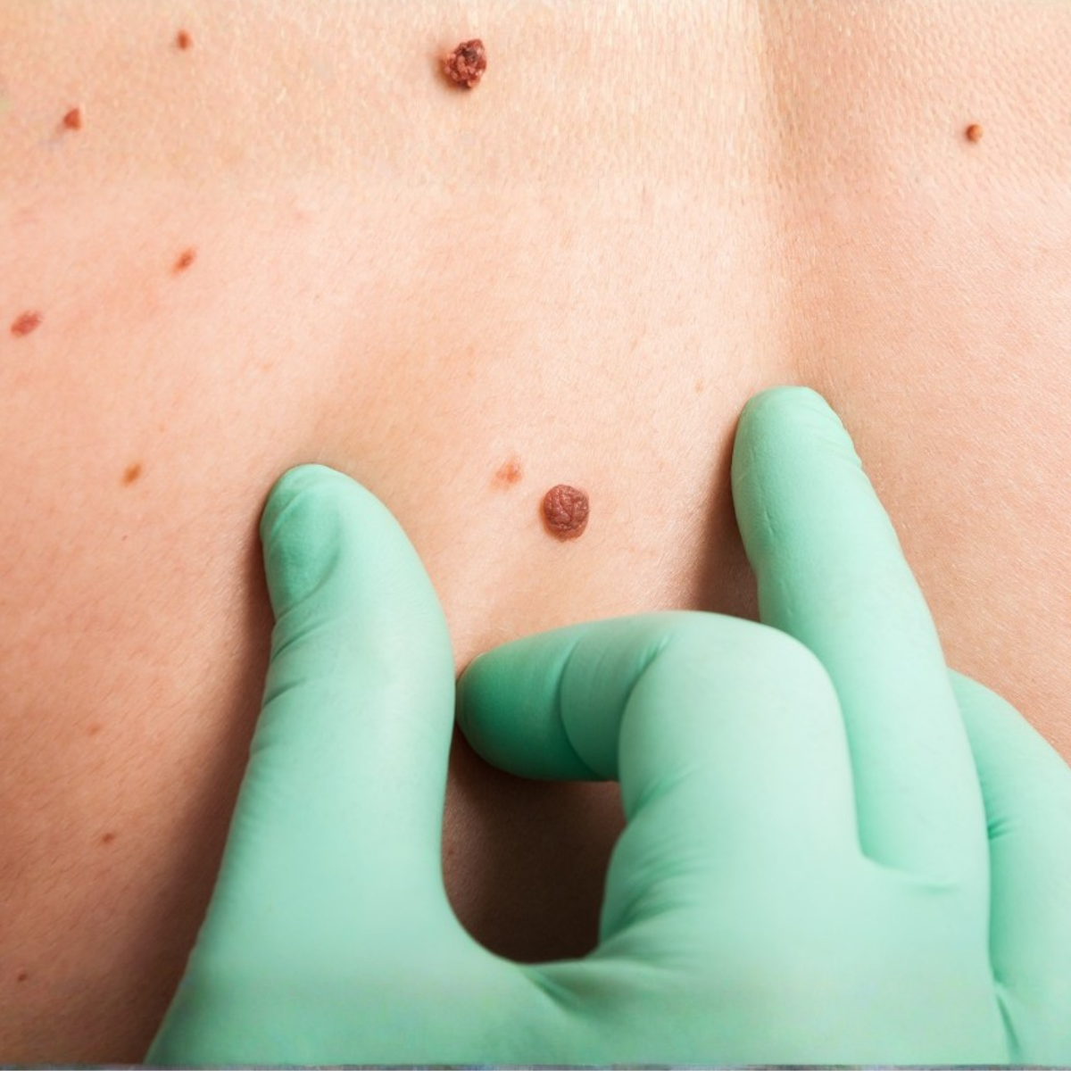 Proderma, dermatología,  clínica, melanoma, cáncer