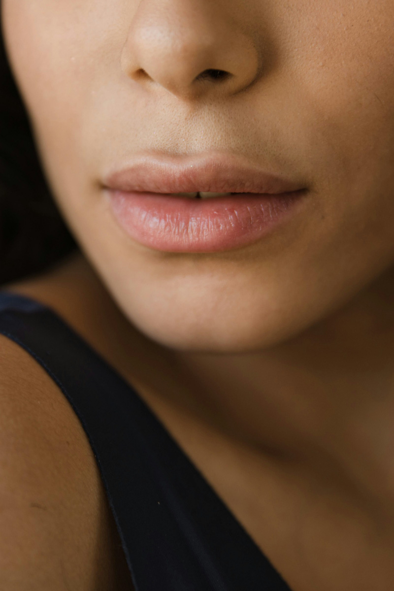 Proderma, dermatología,  ácido hialurónico,  relleno de labios, fillers,  clínica 