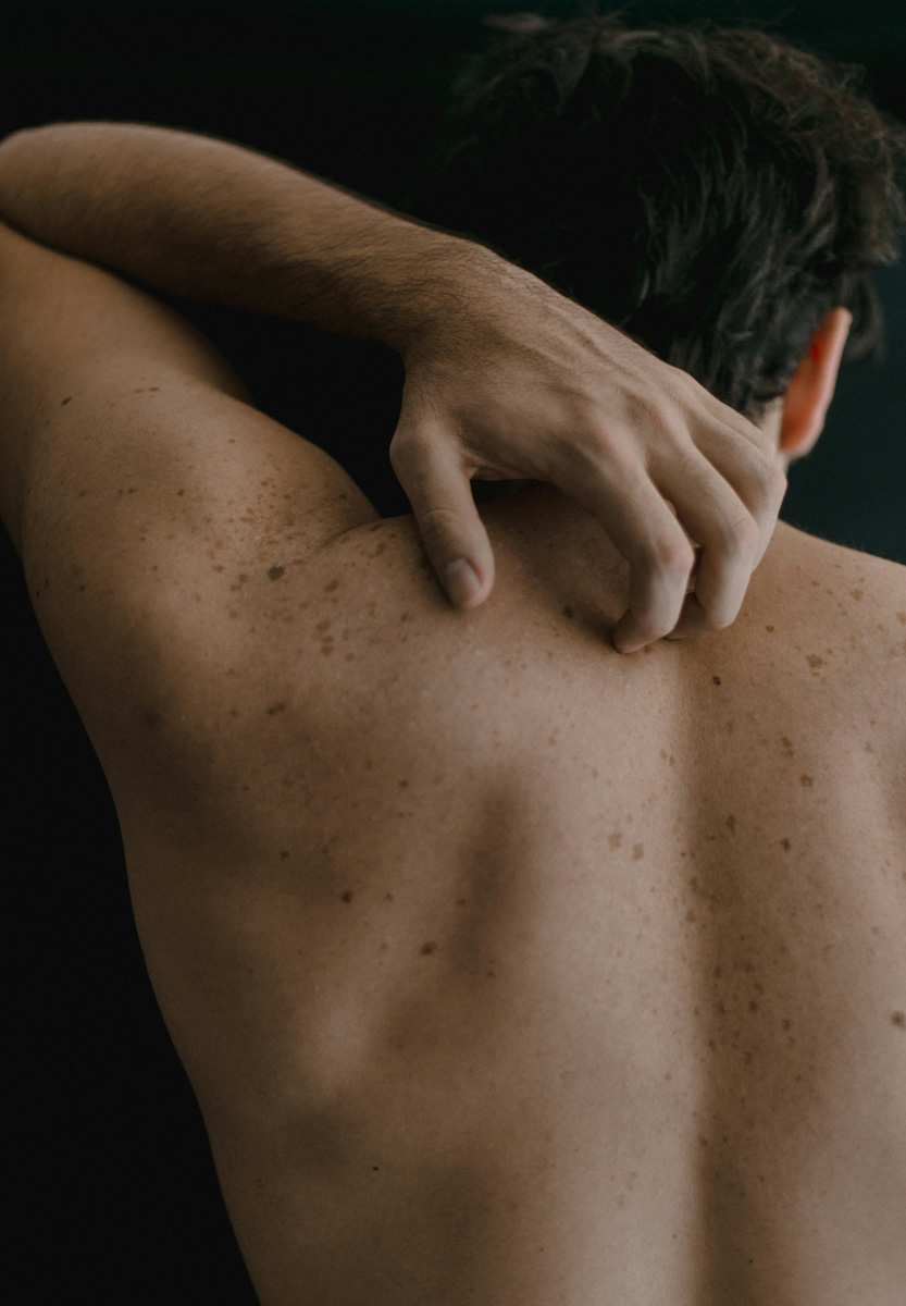 Proderma, lunares, piel, cáncer, clínica