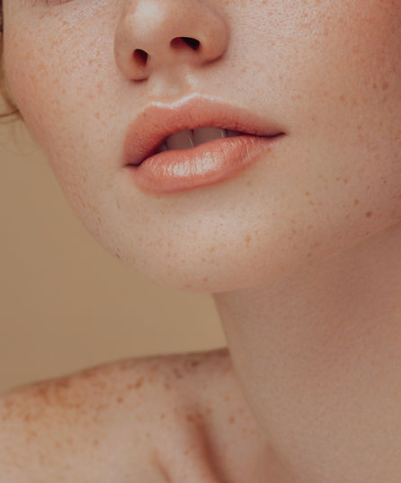 Melasma