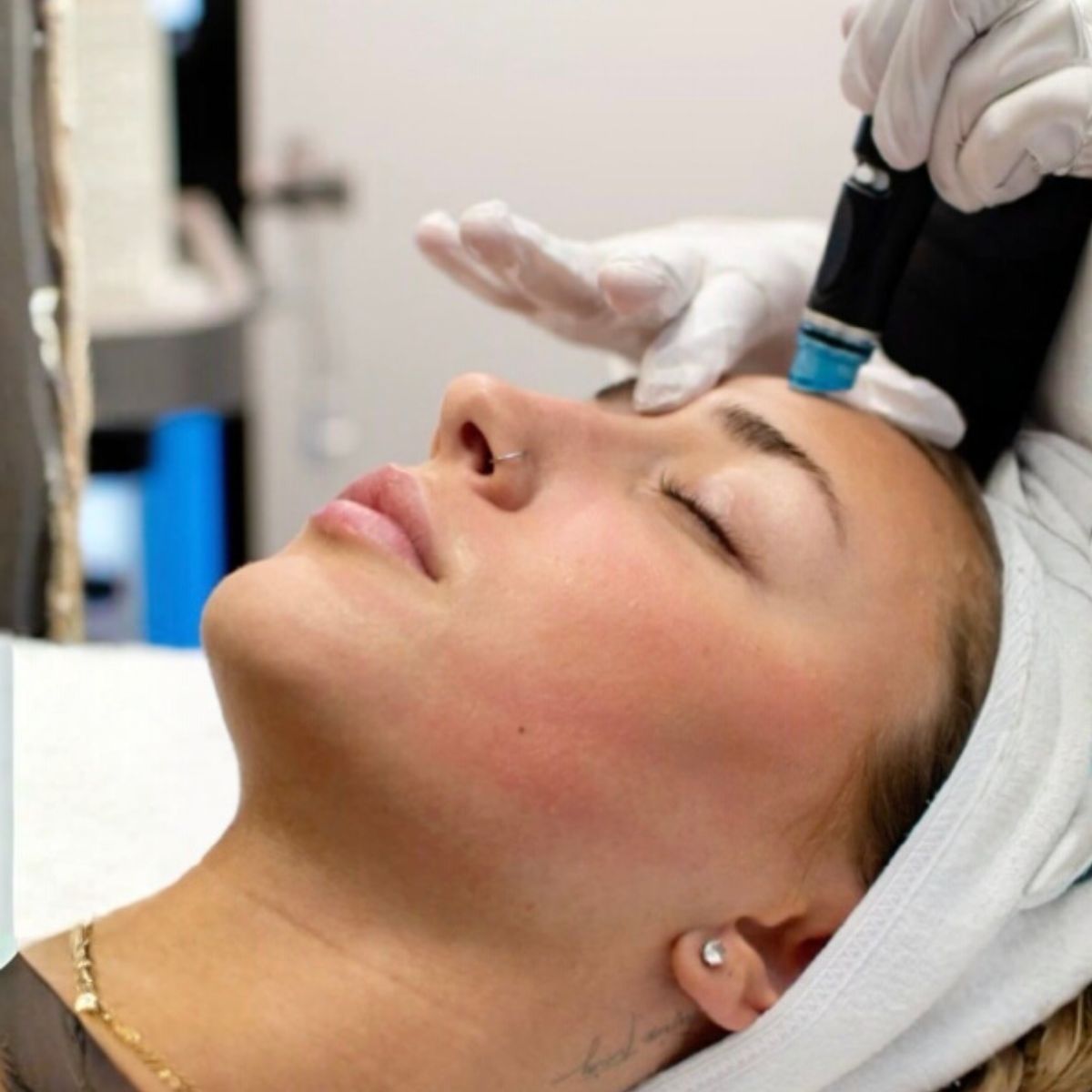 Proderma, dermatología,  peeling, micropeeling