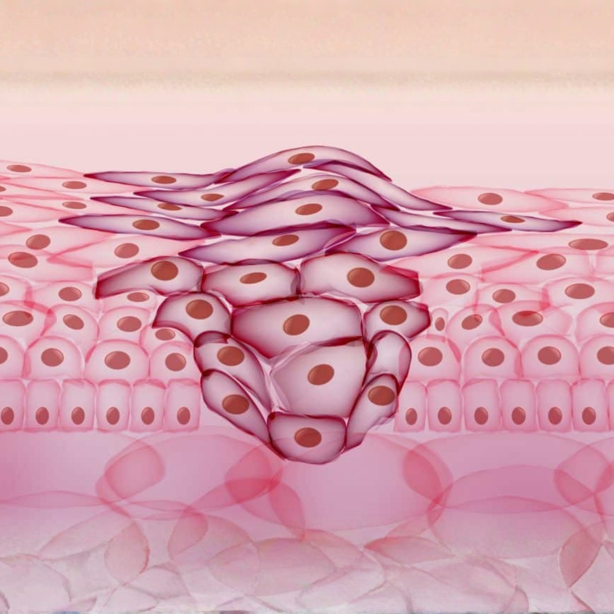 Proderma, dermatología,  precancerosa, cáncer,  neoplasia, clínica 