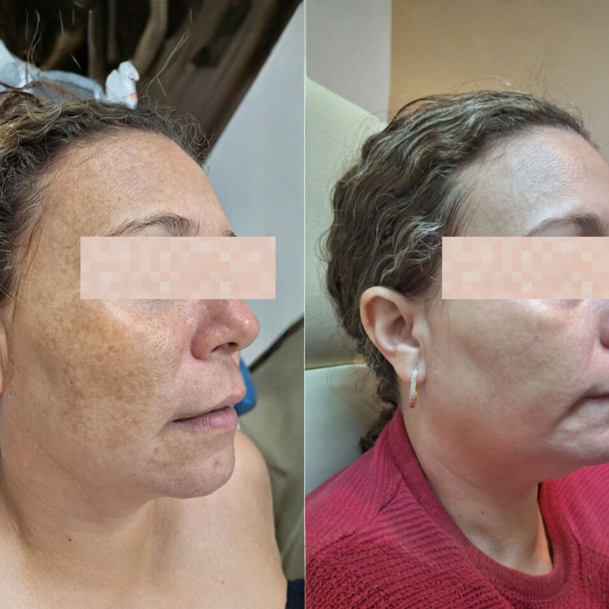 Melasma
