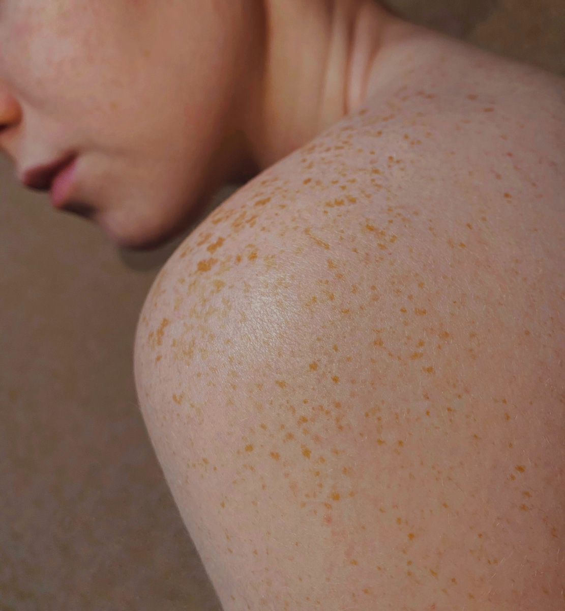 Proderma, dermatología, exposición al sol, cáncer, cáncer de piel,  clínica 
