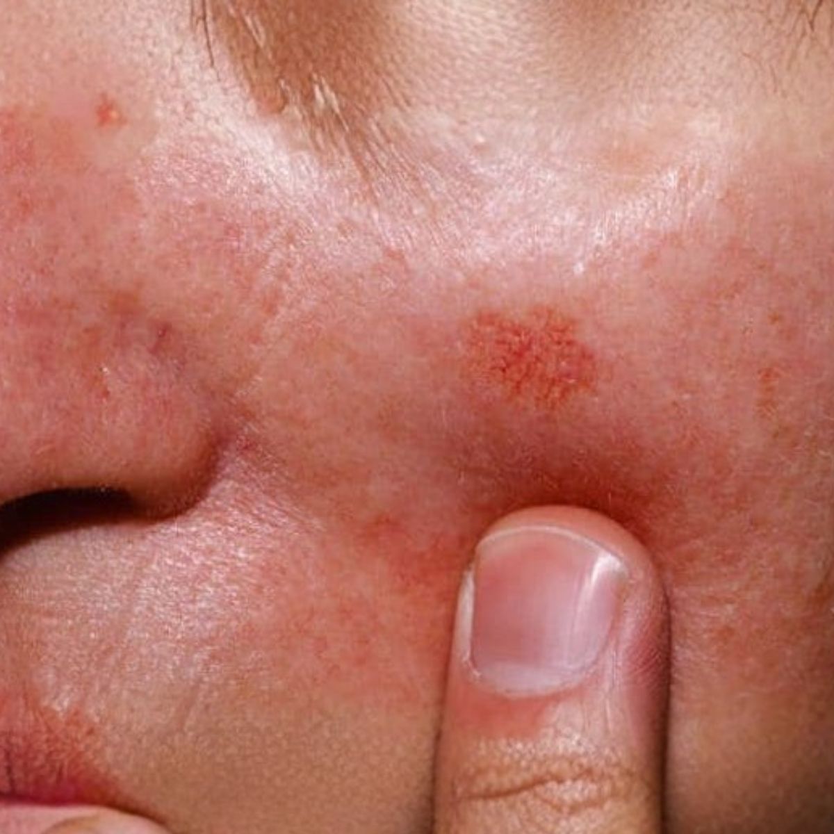 Proderma, dermatología, exposición al sol, cáncer, cáncer de piel,  clínica 