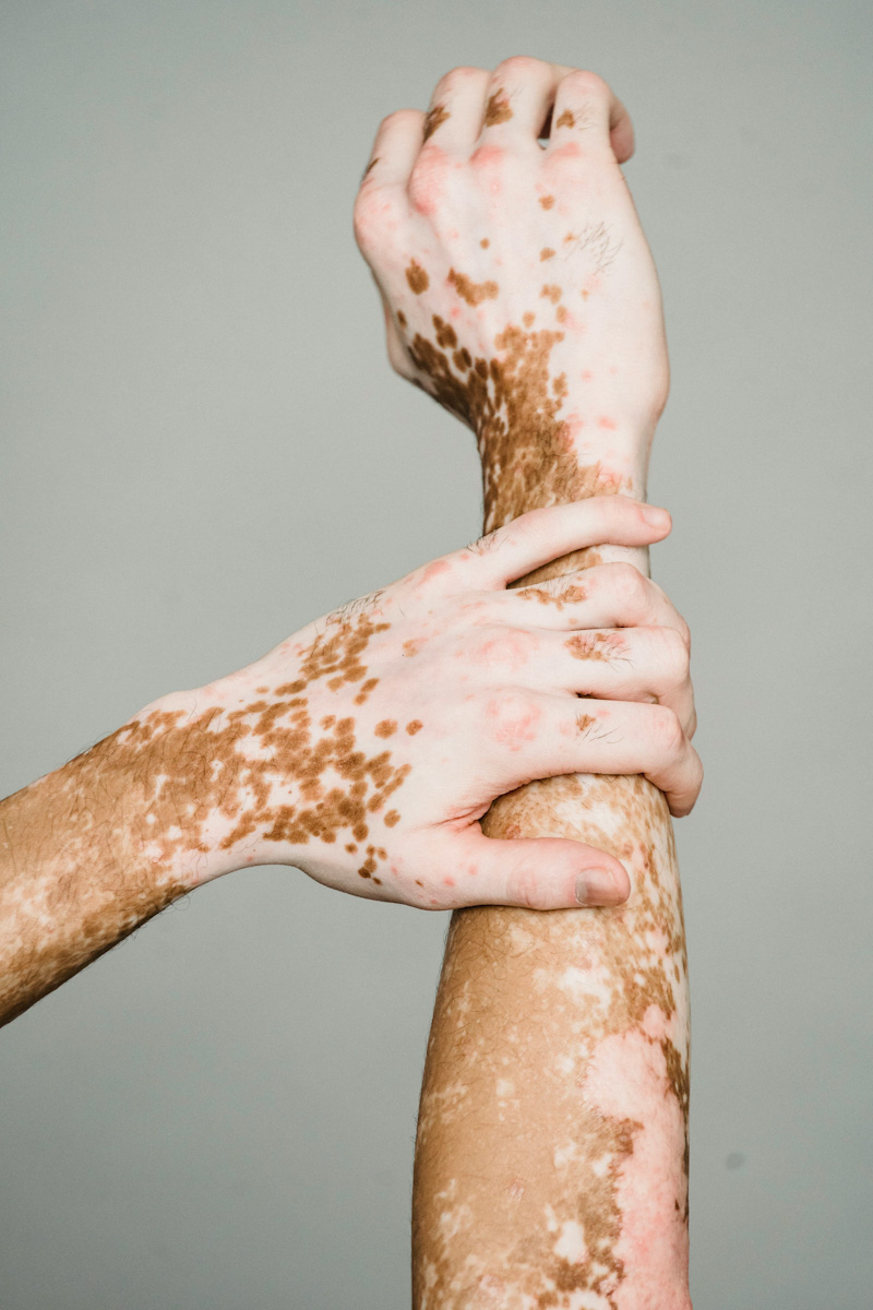 Proderma, dermatología, vitiligio, piel
